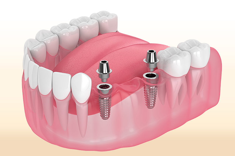 IMPLANT IMPLANT