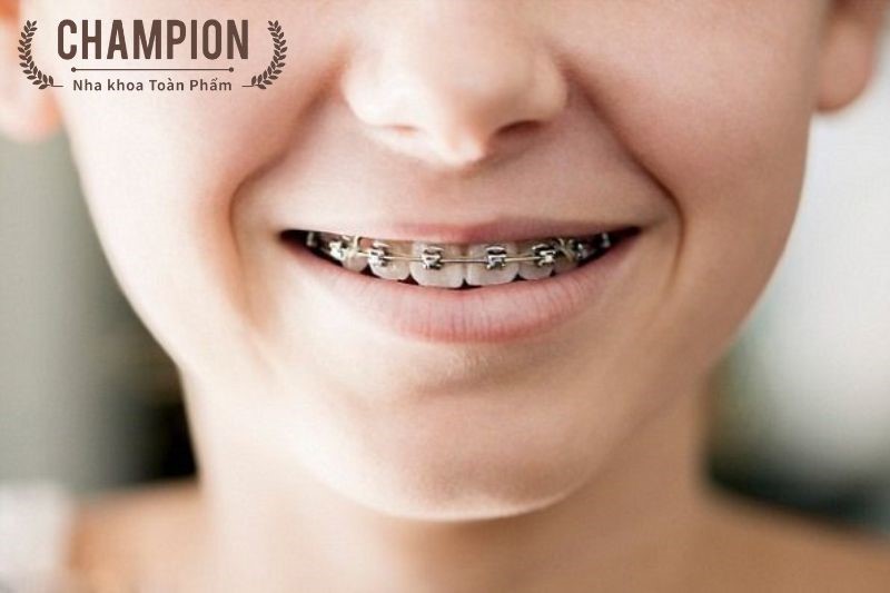 Invisalign and orthodontics