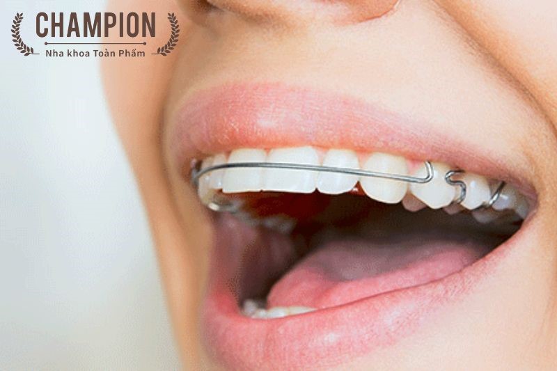 Tại sao phải đeo hàm duy trì sau niềng răng? Điều cần lưu ý sau niềng răng