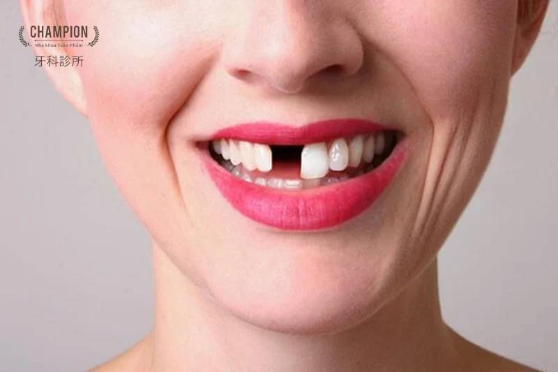 Mất răng có nghiêm trọng không? Cần lưu ý gì khi mất răng?
