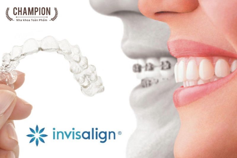 Invisalign clear braces