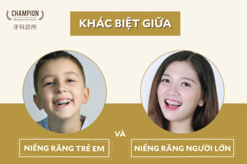 Sự khác biệt giữa niềng răng ở trẻ em và người lớn