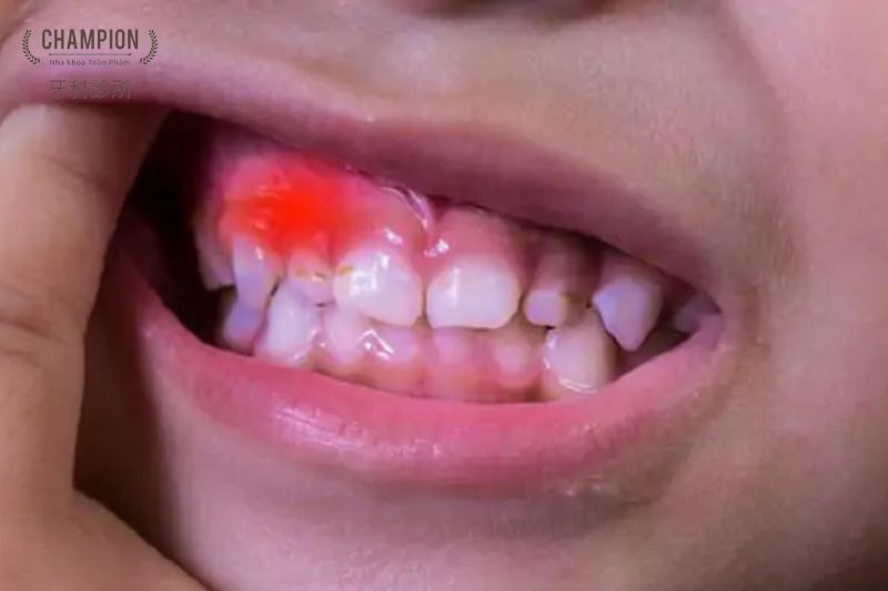 Nguyên nhân và cách xử lý khi bị viêm nướu ở trẻ em