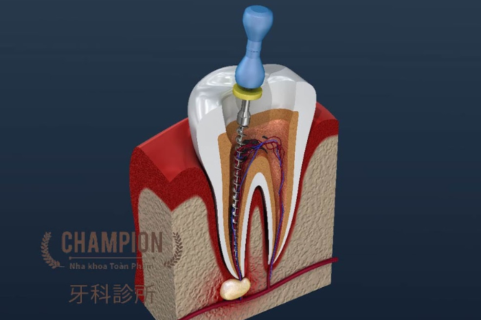 Điều trị nha chu