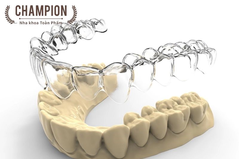 Is it true that there are invisible braces?