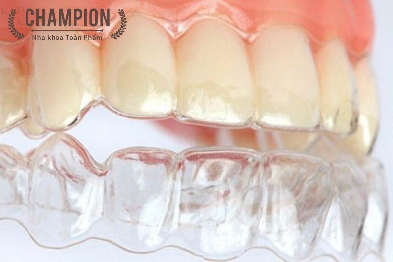 Retainers and dental braces