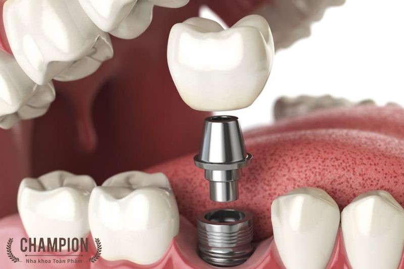 IMPLANT