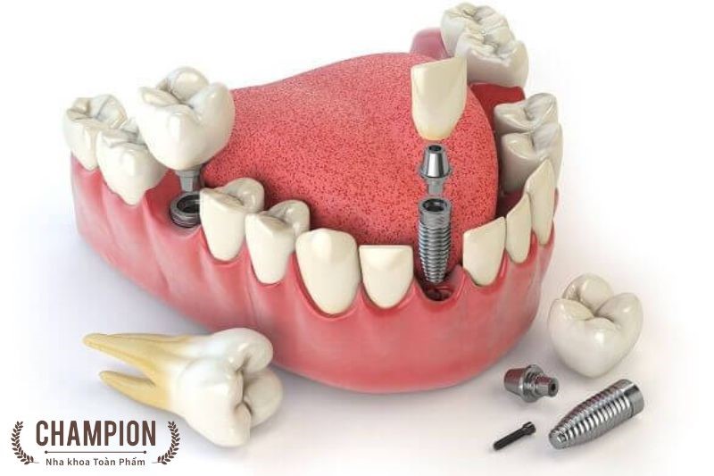 Implant Nobel Biocare (Thuỵ Sĩ) Implant Nobel Biocare (Thuỵ Sĩ)