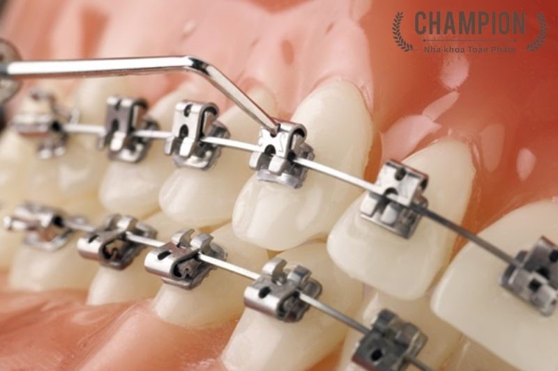 Self-ligating metal braces