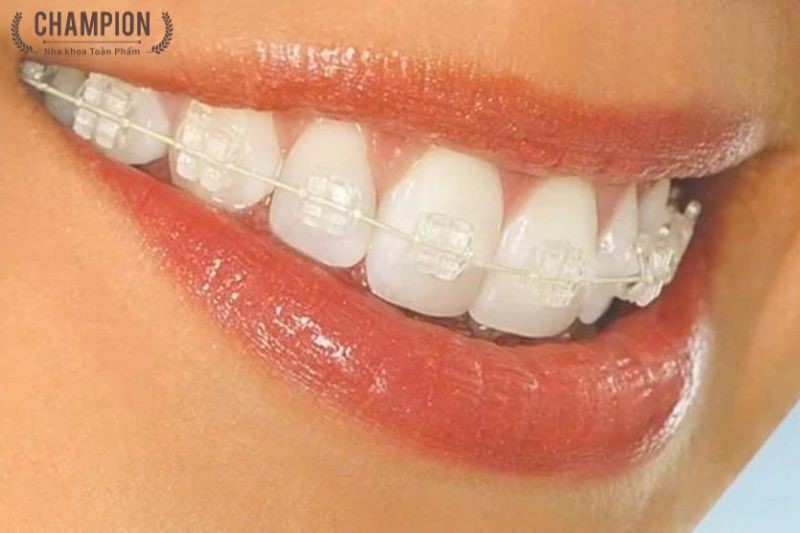 Mắc cài pha lê tự đóng