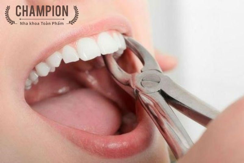 Niềng răng có phải nhổ răng không? Giải đáp các thắc mắc về niềng răng