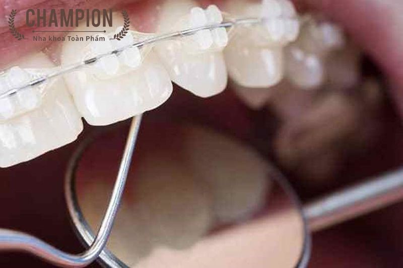 Niềng răng mắc cài pha lê là gì? Đặc điểm và chi phí