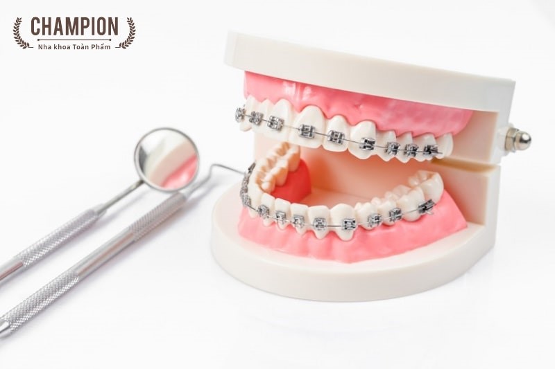 Traditional braces