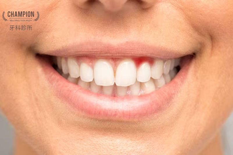 Răng nướu bị viêm: Triệu chứng, nguyên nhân và cách điều trị