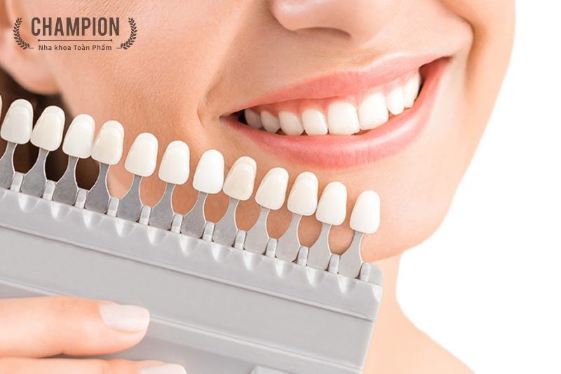 Trám răng thẩm mỹ