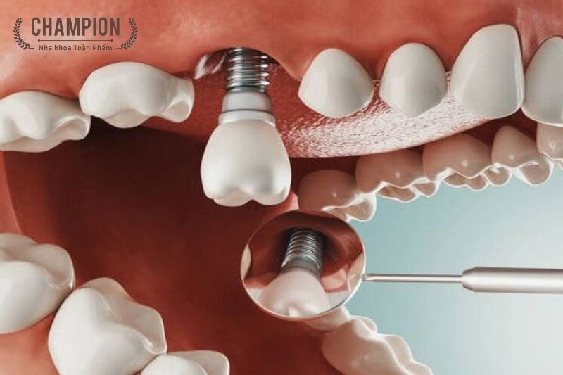 Implantation surgery Implantation surgery
