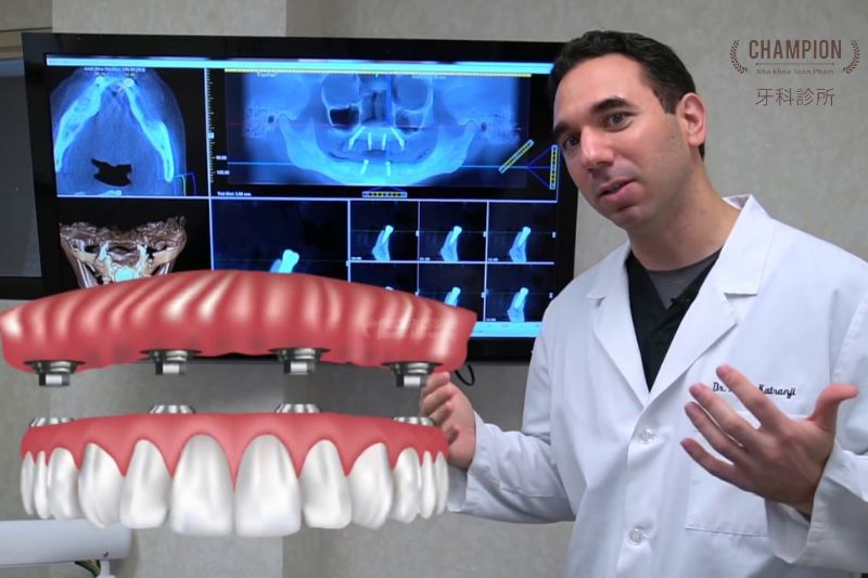 Trồng Răng Implant All-On-4 Trồng Răng Implant All-On-4