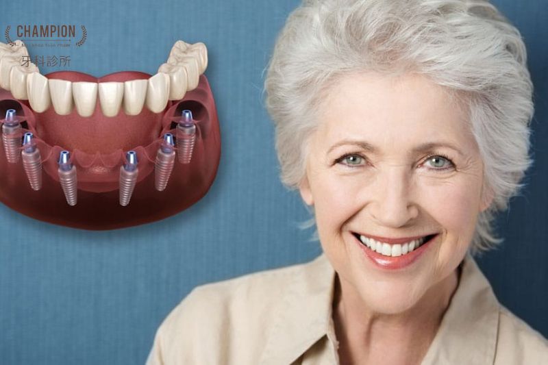 Trồng Răng Implant All-On-6 Trồng Răng Implant All-On-6