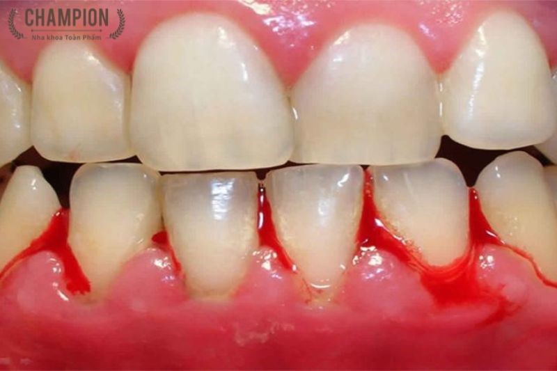 Điều trị viêm nướu
